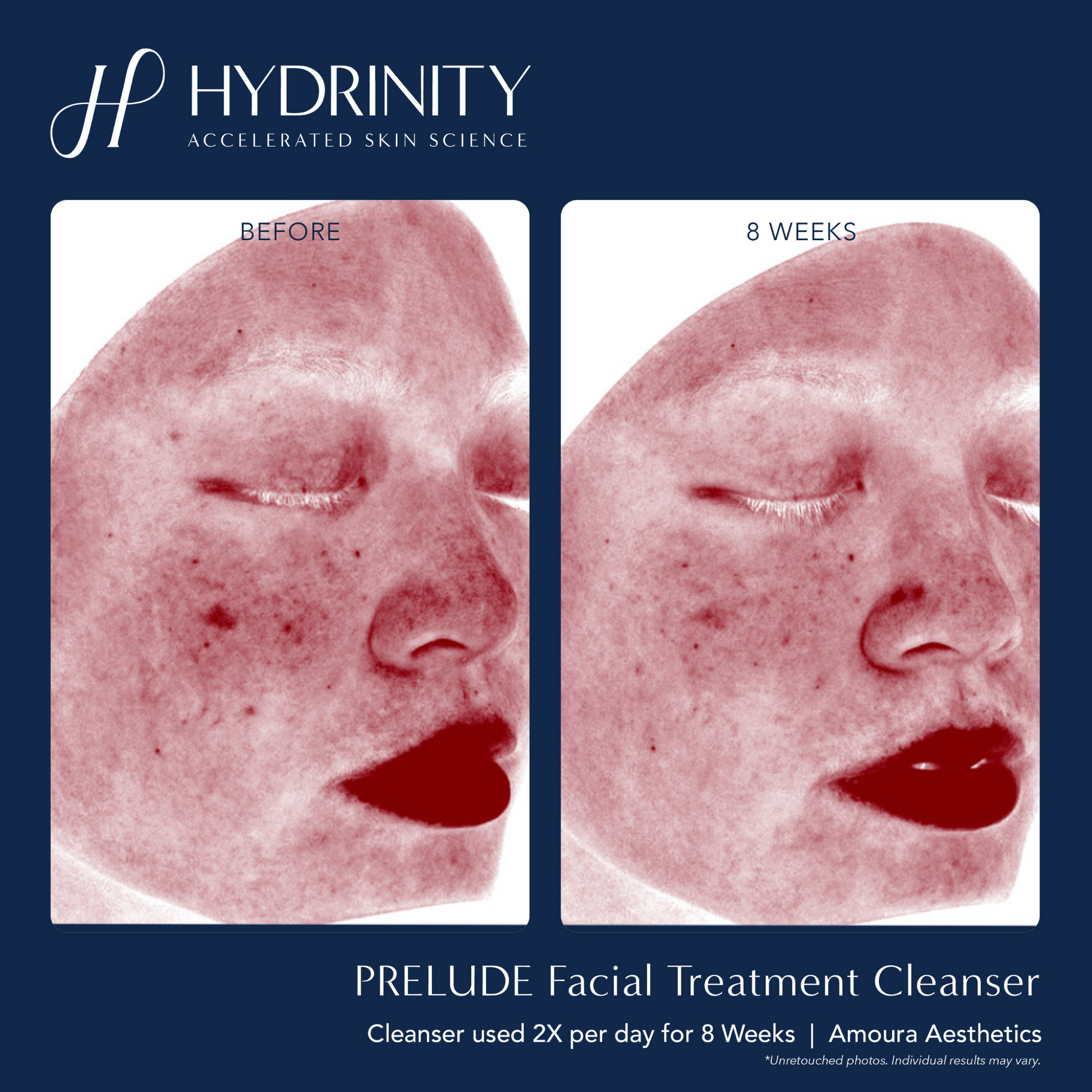 PRELUDE Facial Treatment Cleanser - MariposaSkincare.com